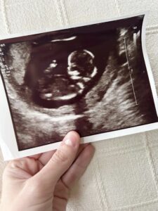 Miscarriage grief at christmas. My hand holding the sonogram of the baby we lost.